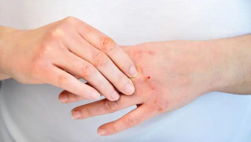 Protein Yetersizliği Belirtileri: 6 İşaretle Dikkat Edin